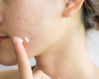 Sử dụng kem bôi trị dị ứng da mặt đúng cách