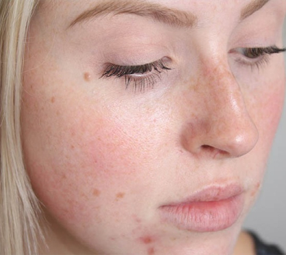 Da mặt sau khi tái tạo sẽ rất yếu và dễ bị tổn thương