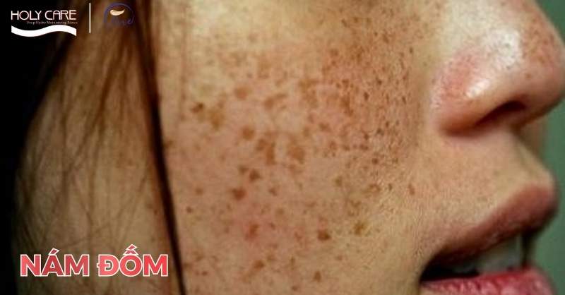 Nám đốm – nám chân sâu khó cải thiện