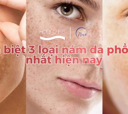 Phân Biệt 3 Loại Nám Phổ Biến Nhất Thường Xuất Hiện Trên Da