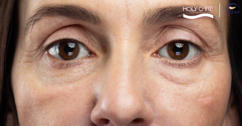 Da quanh mắt xỉn, mỏng & dễ chùng