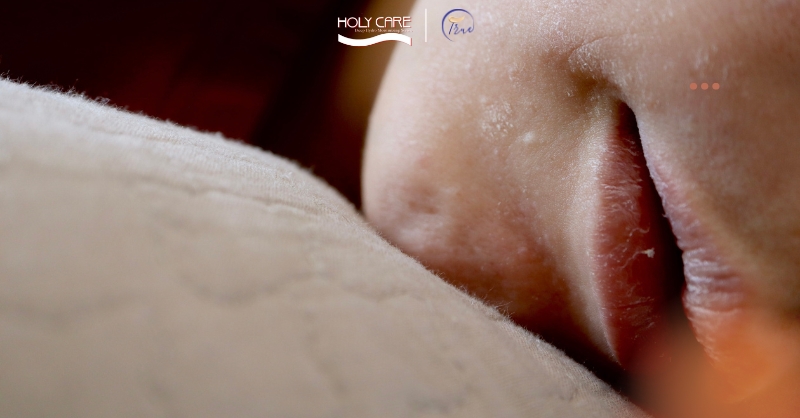 Da khô, da thiếu ẩm