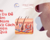 3 Lý Do Khiến Da Dễ Bị Thâm Mụn, Nám Sạm Và Cách Cải Thiện Hiệu Quả